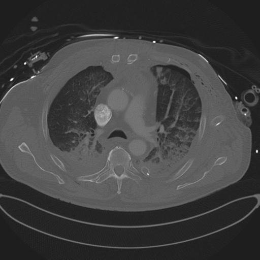 Cardiac trauma (Radiopaedia 32874-33858 Axial bone window 33).jpg