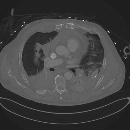 Cardiac trauma (Radiopaedia 32874-33858 Axial bone window 44).jpg