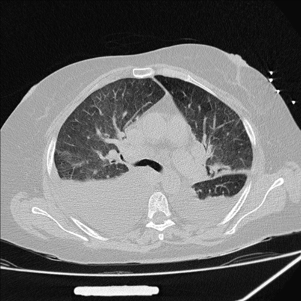 Cardiogenic pulmonary edema (Radiopaedia 29213-29609 Axial lung window 35).jpg
