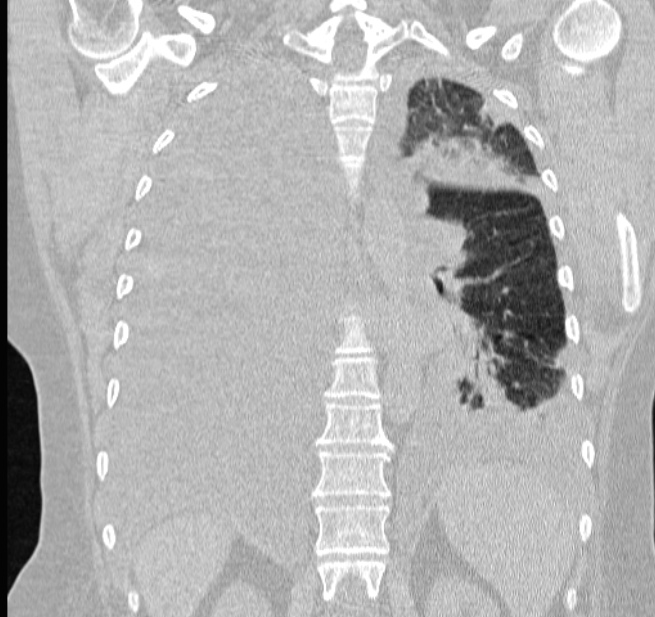 Cardiogenic pulmonary edema (Radiopaedia 29213-29609 Coronal lung window 47).jpg