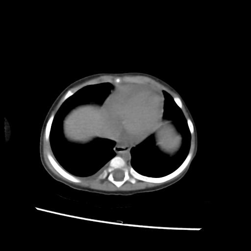 File:Caroli disease with autosomal recessive polycystic kidney disease (ARPKD) (Radiopaedia 89651-106703 Axial non-contrast 3).jpg