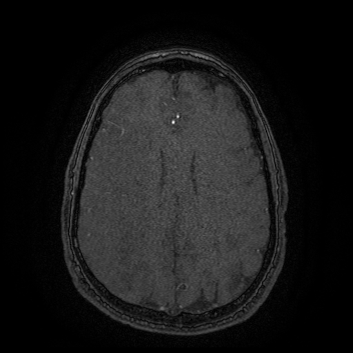 Carotid arterial dissection with acute cerebral infarction (Radiopaedia 26636-26784 MRA 43).jpg