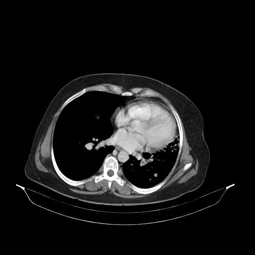 File:Carotid body tumor (Radiopaedia 21021-20948 B 45).jpg