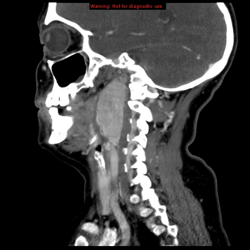 Carotid body tumor with lung metastases (Radiopaedia 9301-9986 Sagittal C+ delayed 33).jpg