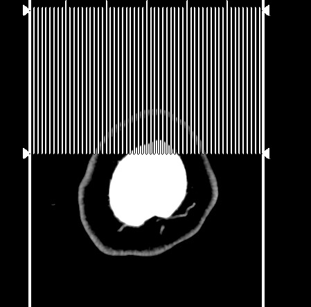 Carotid canal sympathetic schwannoma (Radiopaedia 68925-78671 Sagittal venous 1).jpg