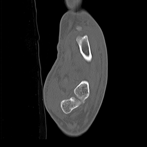 File:Carpo-metacarpal fracture-dislocations with hamatum split fracture (Radiopaedia 18482-18343 Sagittal bone window 23).jpg