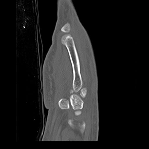 File:Carpo-metacarpal fracture-dislocations with hamatum split fracture (Radiopaedia 18482-18343 Sagittal bone window 6).jpg