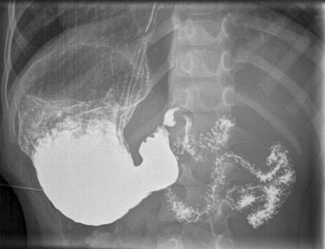 File:Caustic esophageal stricture (Radiopaedia 67290-76661 C 1).PNG
