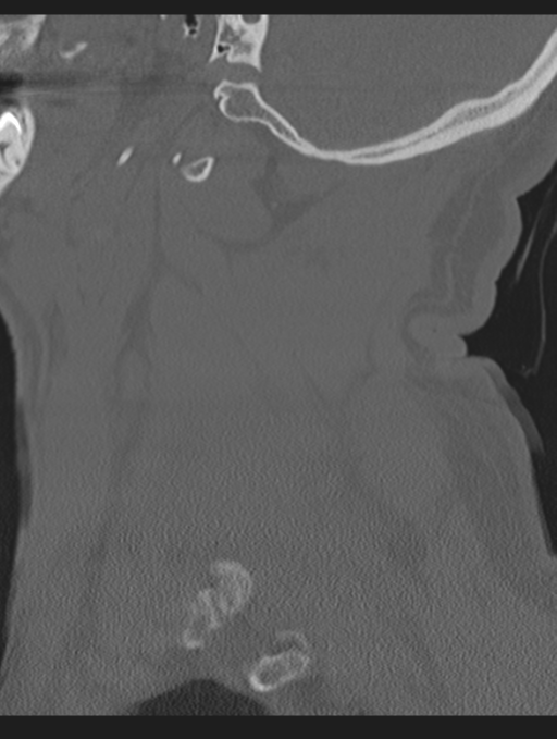 Cavernoma of cervical cord (Radiopaedia 50838-56346 Sagittal bone window 17).png