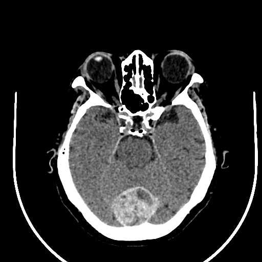Cavernous hemangioma of the cerebellar falx (Radiopaedia 73025-83723 Axial non-contrast 46).jpg
