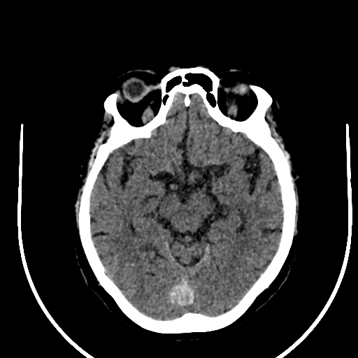 Cavernous hemangioma of the cerebellar falx (Radiopaedia 73025-83723 Axial non-contrast 57).jpg