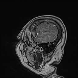 Cavernous sinus meningioma (Radiopaedia 63682-72367 Sagittal T1 C+ 146).jpg