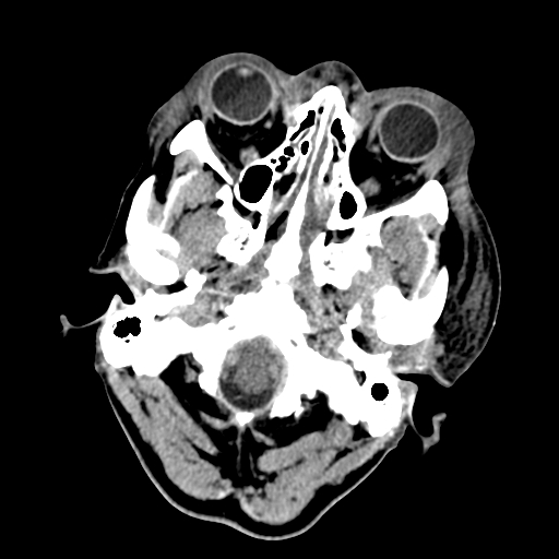 File:Cavernous sinus thrombosis (Radiopaedia 10619-11078 Axial non-contrast 3).jpg