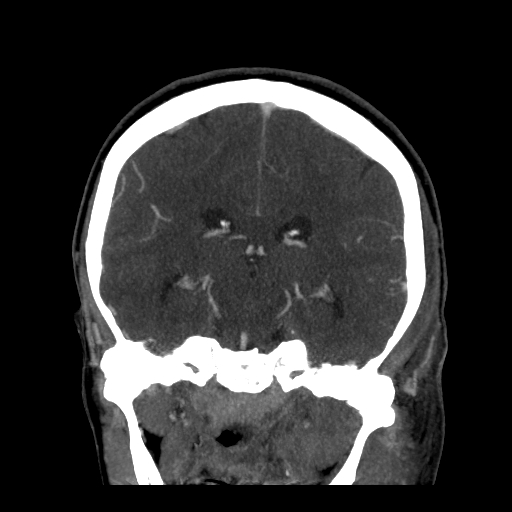 File:Cavernous sinus thrombosis (Radiopaedia 10619-11078 D 17).jpg