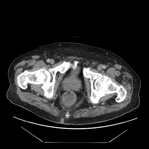 Cecal adenocarcinoma (Radiopaedia 64871-73817 A 94).jpg