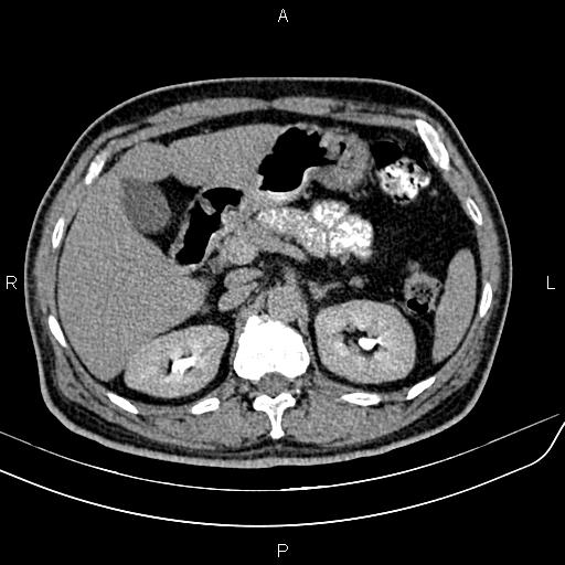 File:Cecal cancer with appendiceal mucocele (Radiopaedia 91080-108651 Axial C+ delayed 13).jpg