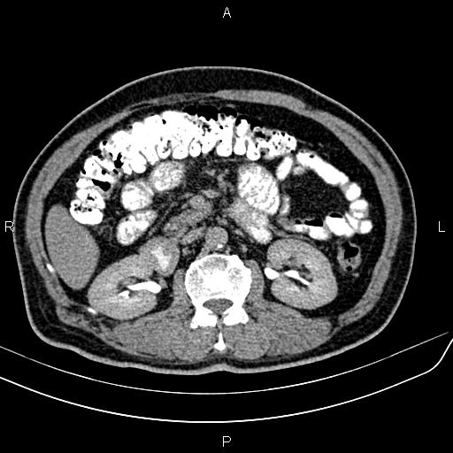 File:Cecal cancer with appendiceal mucocele (Radiopaedia 91080-108651 Axial C+ delayed 24).jpg