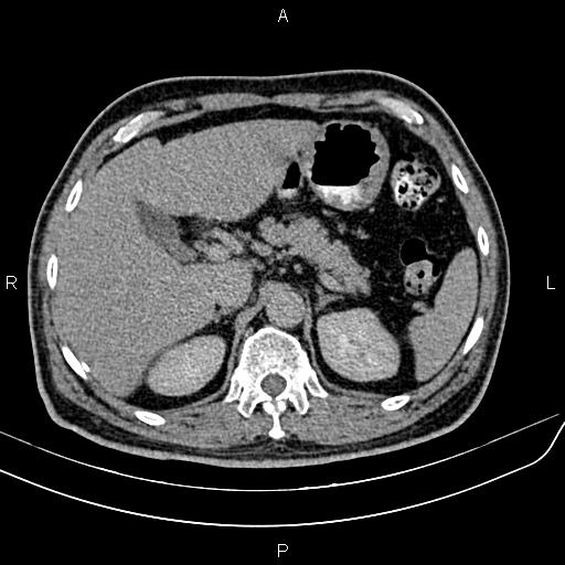 File:Cecal cancer with appendiceal mucocele (Radiopaedia 91080-108651 Axial C+ delayed 9).jpg