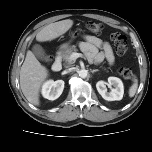 File:Cecal mass causing appendicitis (Radiopaedia 59207-66531 A 30).jpg