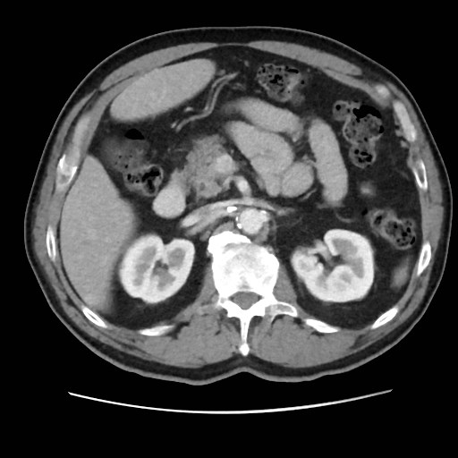 File:Cecal mass causing appendicitis (Radiopaedia 59207-66531 A 31).jpg
