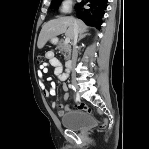 Cecal mass causing appendicitis (Radiopaedia 59207-66531 C 28).jpg