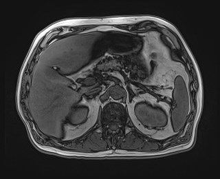 Cecal mass causing appendicitis (Radiopaedia 59207-66532 D 43).jpg