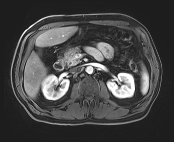 Cecal mass causing appendicitis (Radiopaedia 59207-66532 H 55).jpg