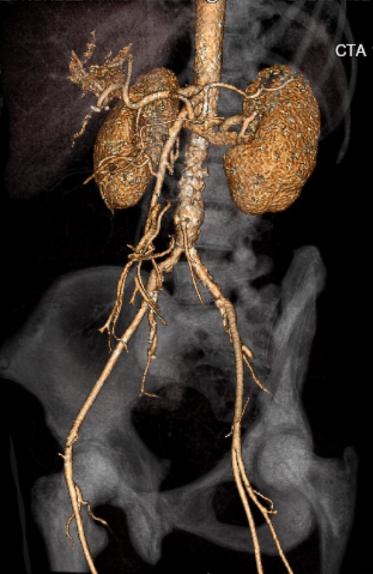 File:Celiac artery severe stenosis and dissection (Radiopaedia 44128-47842 C+ arterial phase 26).jpg