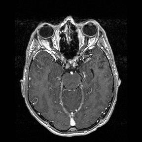 File:Central-variant posterior reversible encephalopathy syndrome (PRES) (Radiopaedia 43880-47358 Axial T1 C+ 56).jpg
