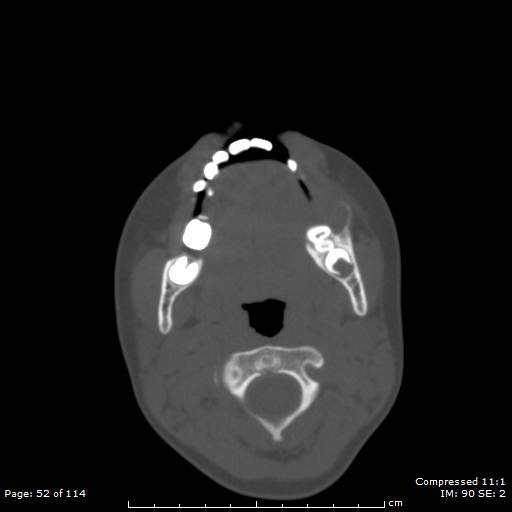File:Central giant cell granuloma (Radiopaedia 45612-49754 Axial bone window 26).jpg