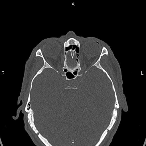 File:Central giant cell granuloma (Radiopaedia 83346-97761 Axial bone window 61).jpg
