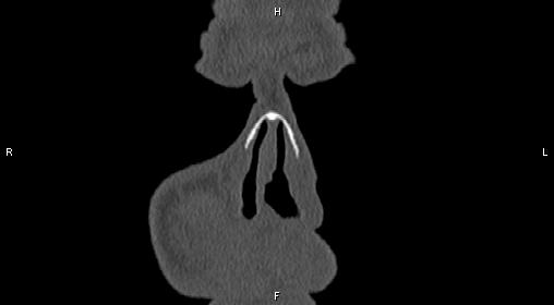 File:Central giant cell granuloma (Radiopaedia 83346-97761 Coronal bone window 1).jpg