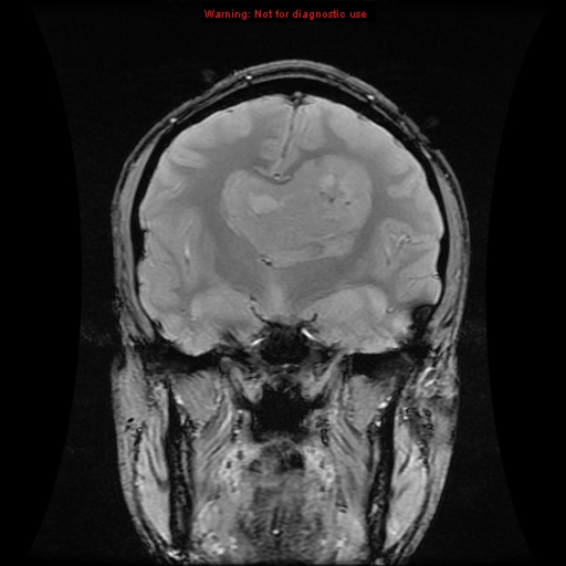 File:Central neurocytoma (Radiopaedia 13188-13206 G 9).jpg