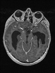 Central neurocytoma (Radiopaedia 56690-63469 Axial T1 C+ 61).jpg