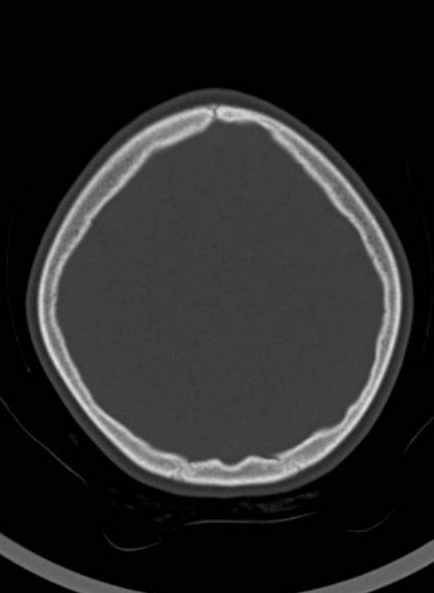 Cerebellar abscess (Radiopaedia 73727-84527 Axial bone window 53).jpg