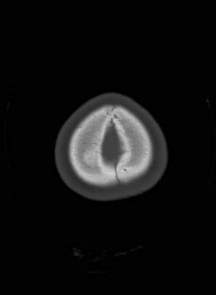 File:Cerebellar abscess (Radiopaedia 73727-84527 Axial bone window 62).jpg