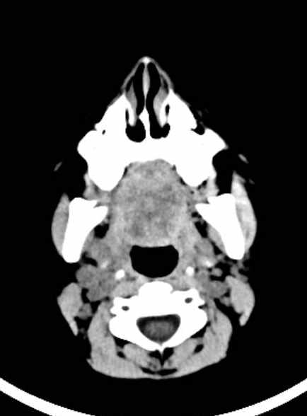 Cerebellar abscess (Radiopaedia 73727-84527 Axial non-contrast 9).jpg