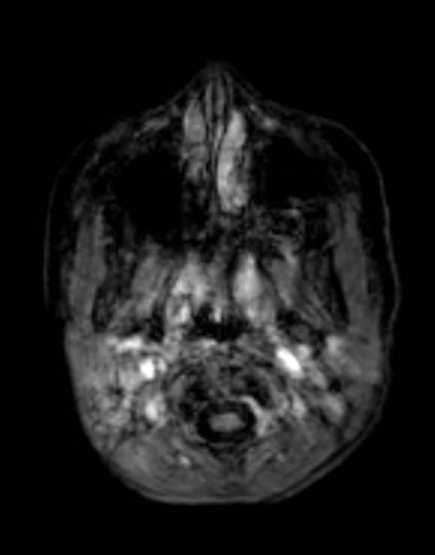 Cerebellar abscess (Radiopaedia 73727-84563 Axial T1 C+ fat sat 22).jpg