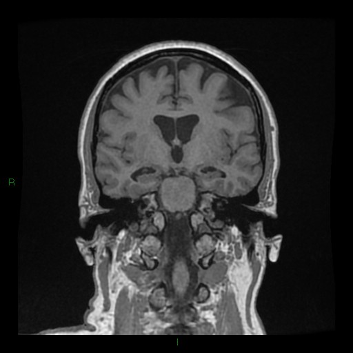 Cerebellar abscess (Radiopaedia 78135-90678 Coronal T1 C+ 81).jpg