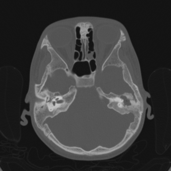 File:Cerebellar abscess secondary to mastoiditis (Radiopaedia 26284-26413 Axial bone window 57).jpg