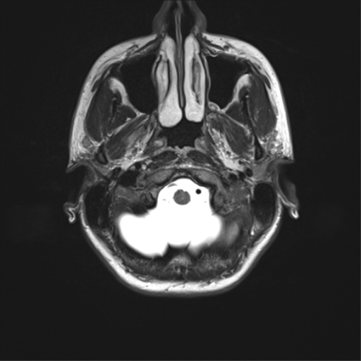 File:Cerebellar agenesis with hypoplastic pons (pontocerebellar hypoplasia) (Radiopaedia 57224-64138 Axial T2 6).png