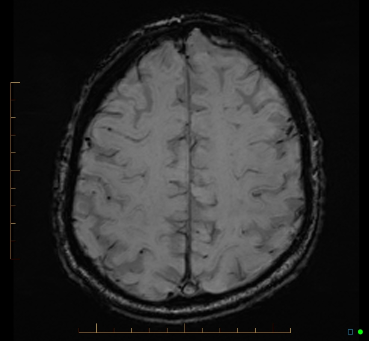 Cerebellar gangliocytoma (Radiopaedia 65377-74422 Axial SWI 45).jpg