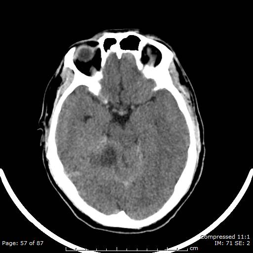 Cerebellar hemangioblastoma (Radiopaedia 52360-58258 Axial non-contrast 57).jpg
