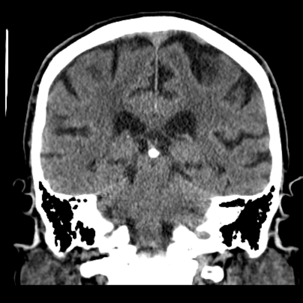 Cerebellar hemorrhage (Radiopaedia 27193-27359 Coronal non-contrast 36).jpg