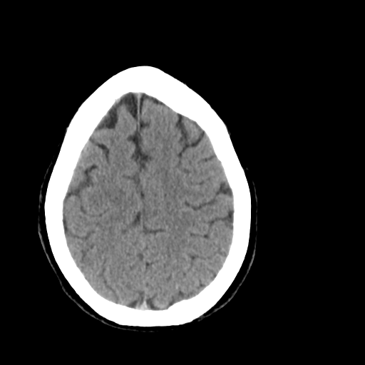 File:Cerebellar infarct due to vertebral artery dissection with posterior fossa decompression (Radiopaedia 82779-97029 Axial non-contrast 23).png