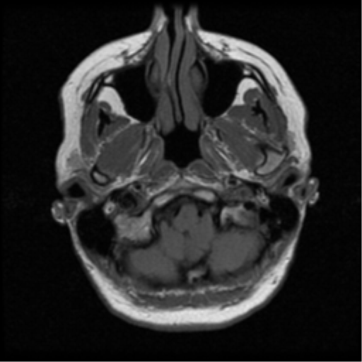 File:Cerebellar metastases - colorectal adenocarcinoma (Radiopaedia 40947-43655 Axial T1 5).png