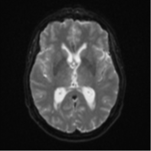Cerebellar metastasis (Radiopaedia 51137-56765 Axial DWI 15).png
