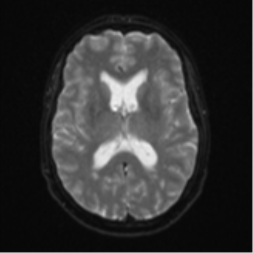 Cerebellar metastasis (Radiopaedia 51137-56765 Axial DWI 16).png
