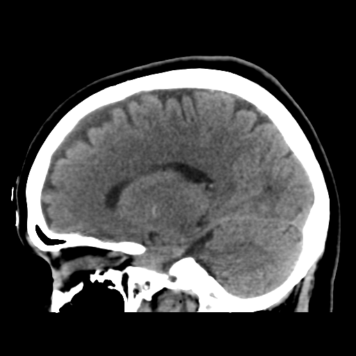 Cerebellar metastasis (cystic appearance) (Radiopaedia 41395-44258 E 24).png