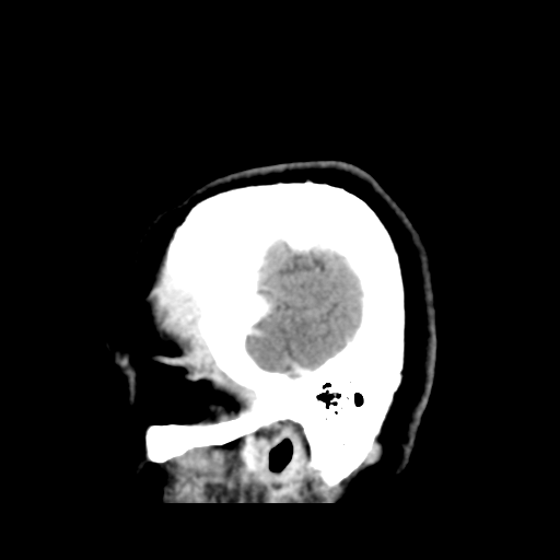 File:Cerebellar metastasis (cystic appearance) (Radiopaedia 41395-44258 F 7).png